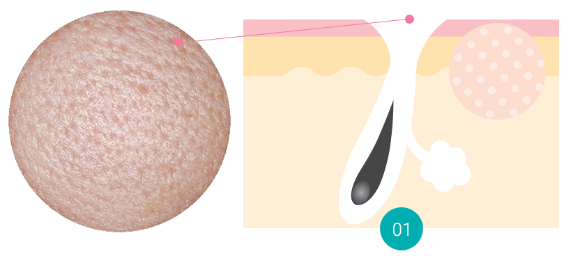 ACNE SCAR PORE