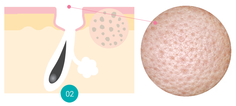 ENLARGED PORE