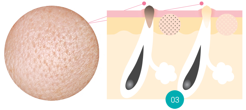 BLACK & WHITE HEAD PORE