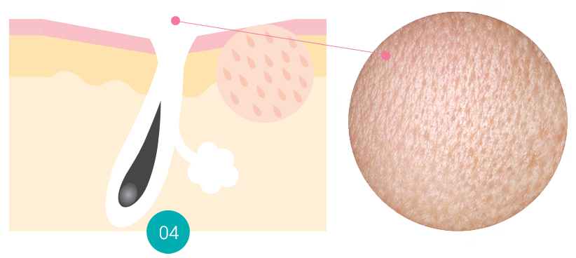 SAGGING PORE