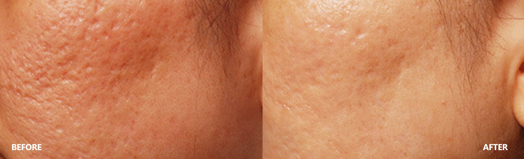 scar-result-6