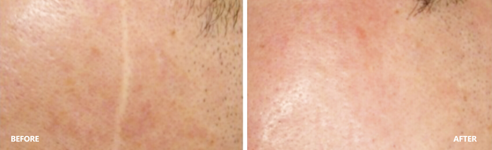 scar-result-8