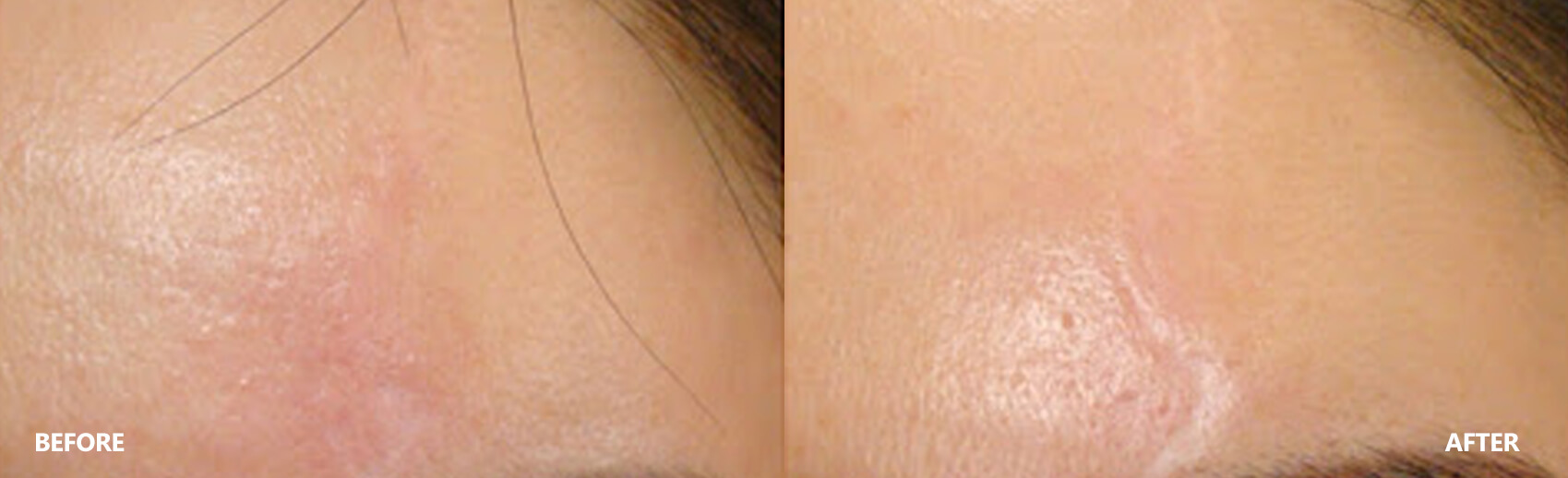scar-result-9