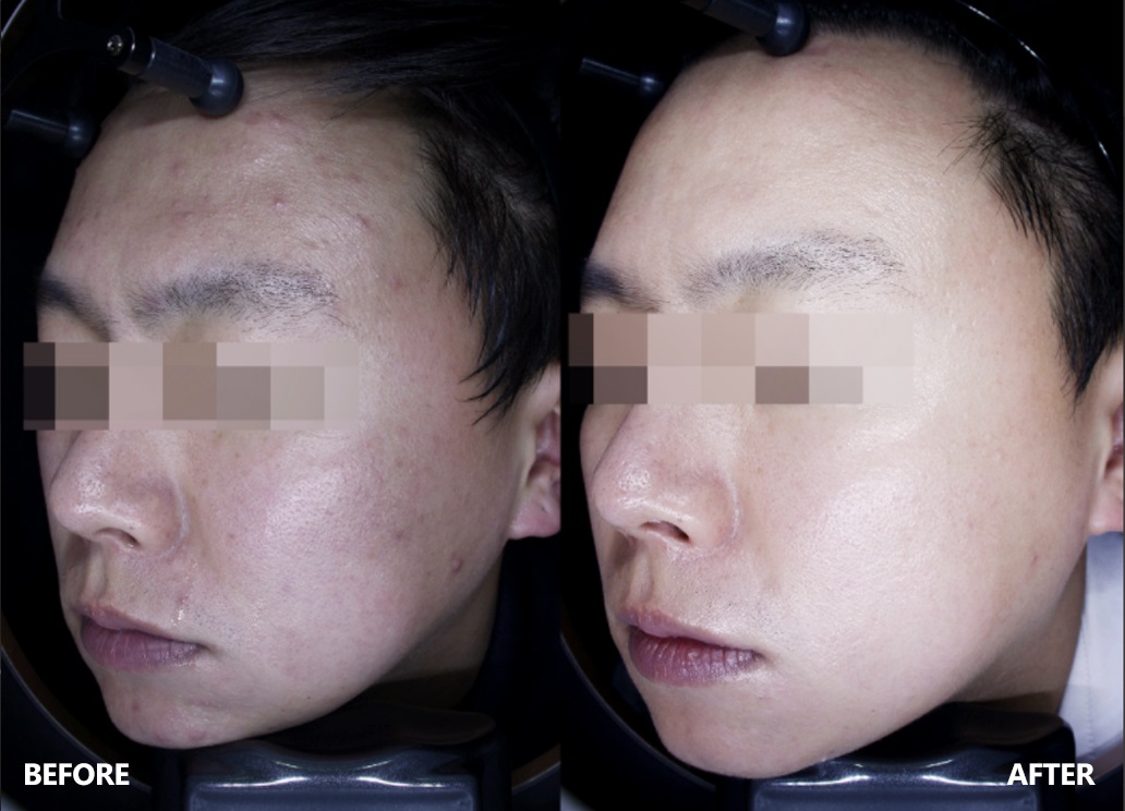 skin-result-4