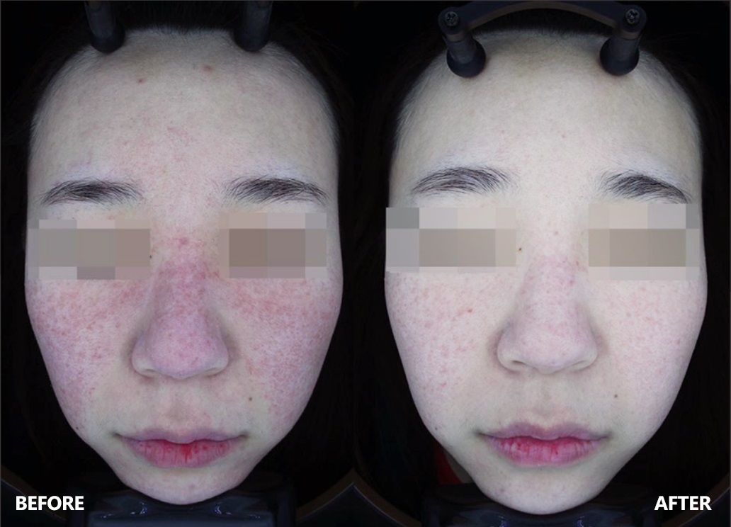 skin-result-5