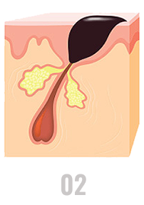 Oil and skin cells plug pores, forming pimples