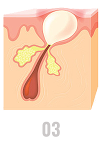 Acne bacteria grow