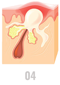 Pimples become inflamed