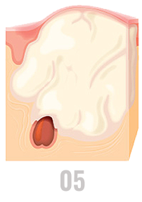 Inflamed pimples can be become painful, scarring may occur