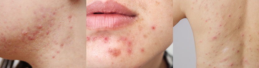 Skin Concern Acne