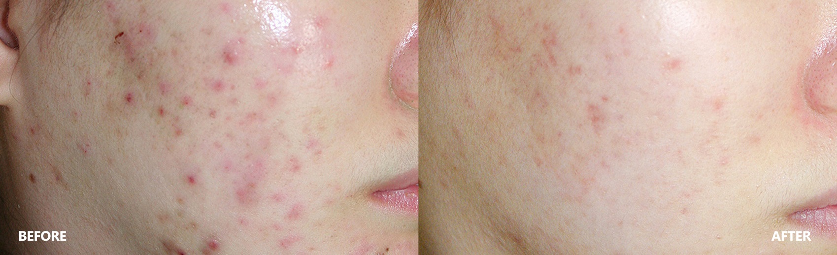 Acne Skin Result Before & After