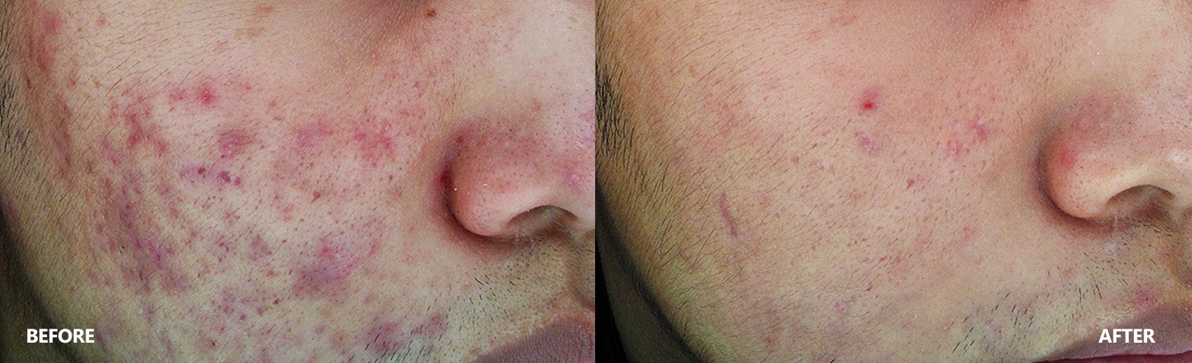 Acne Skin Result Before & After