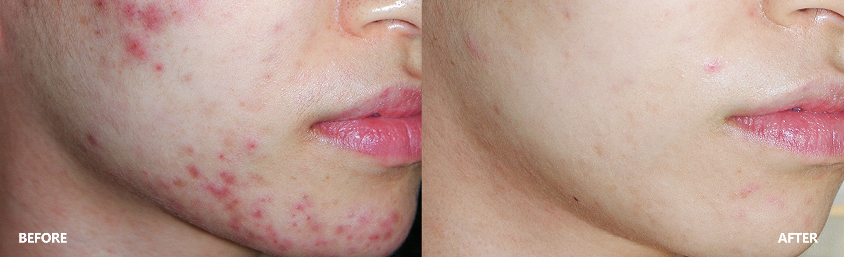 Acne Skin Result Before & After