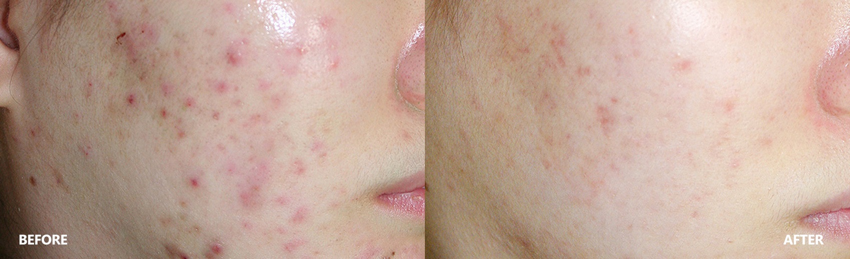 acne-result-banner-2.jpg