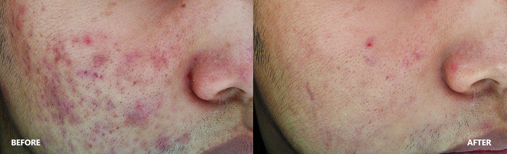 acne-result-banner-3.jpg