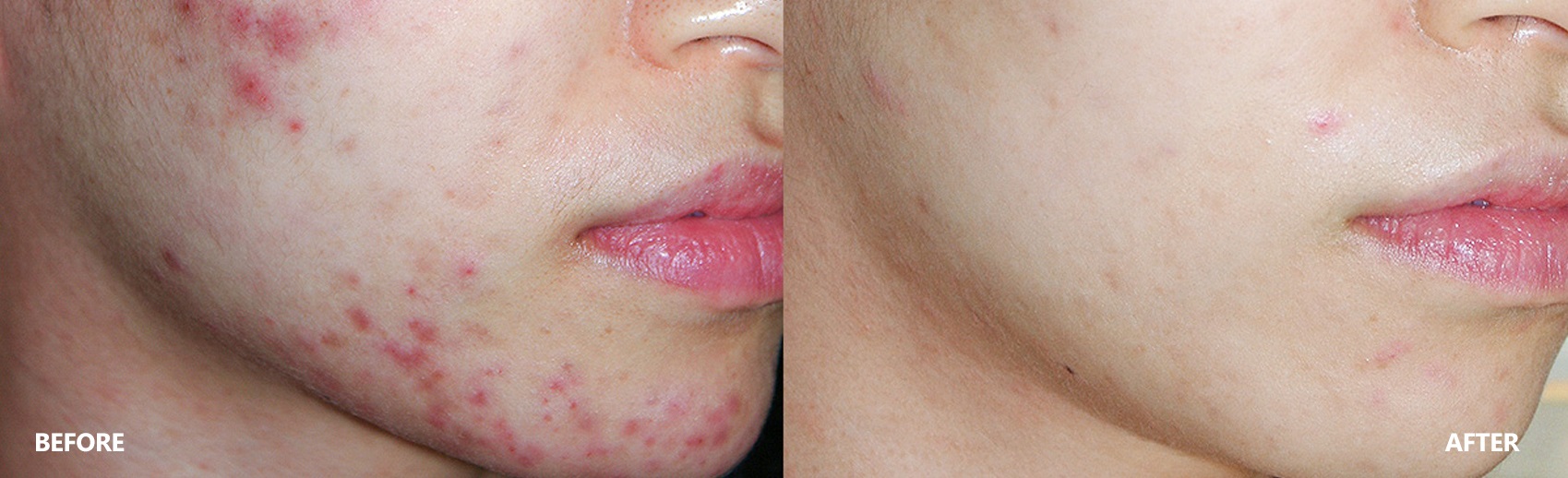 acne-result-banner.jpg